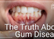 patient showing gums